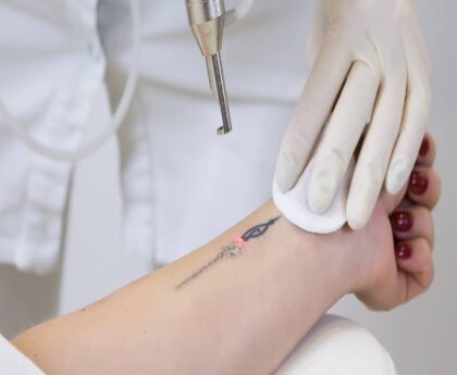 Erasing the Past: Your Guide to Tattoo Removal in Abu Dhabi